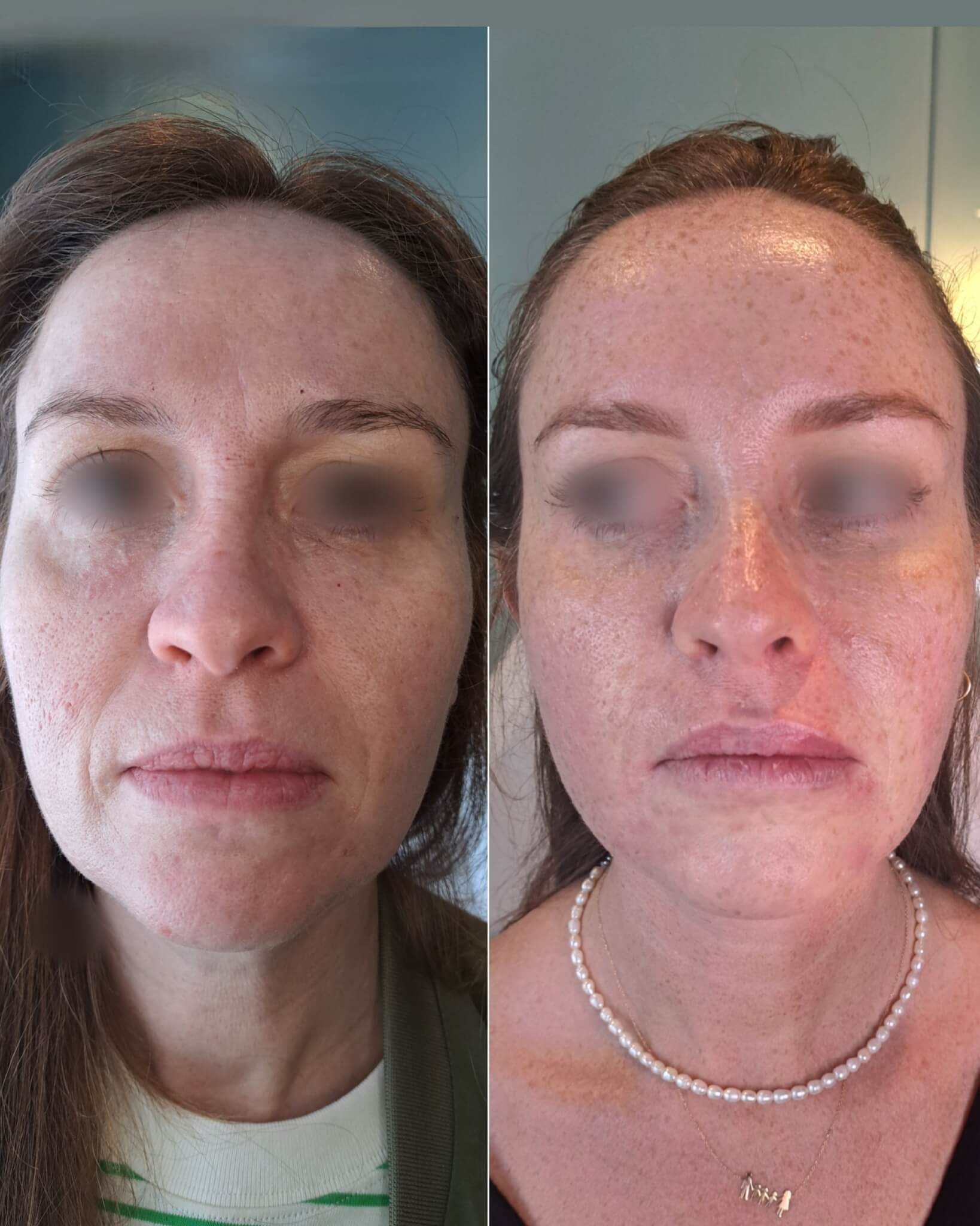 restylane αποτέλεσματα